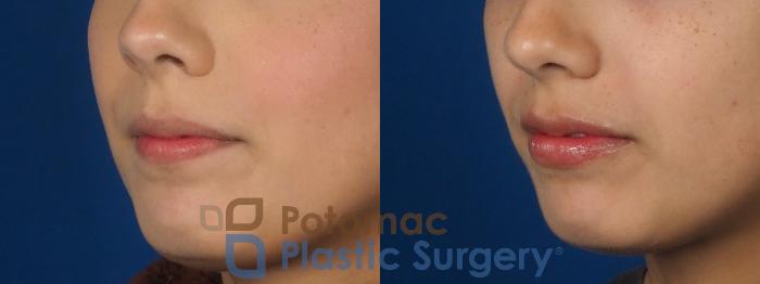 Before & After Lip Augmentation Case 306 Left Oblique View in Washington DC & Arlington , DC