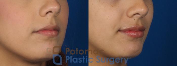 Before & After Lip Augmentation Case 306 Right Oblique View in Washington DC & Arlington , DC