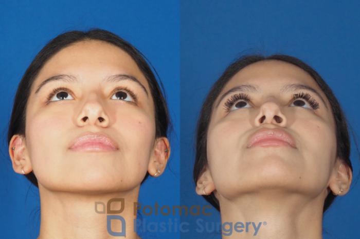 Before & After Liquid Facelift Case 308 Bottom View in Washington DC & Arlington , DC