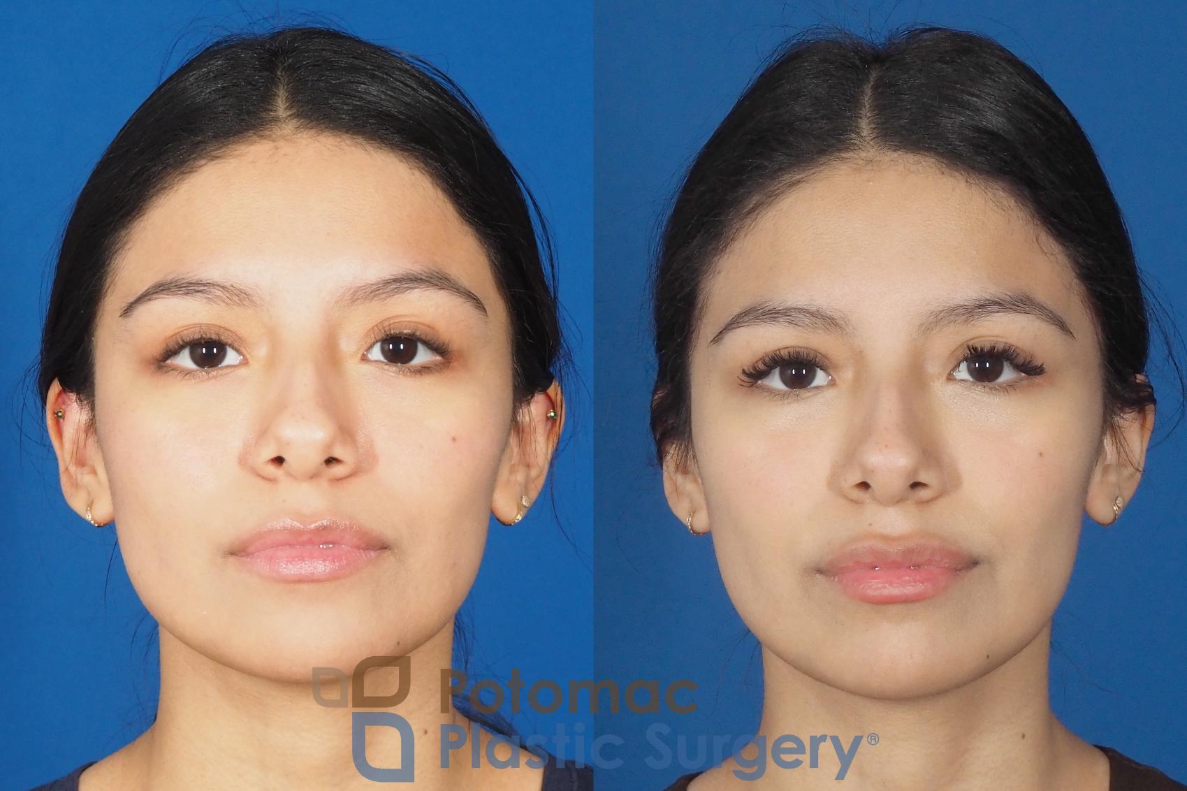 Before & After Dermal Fillers Case 308 Front View in Washington, DC