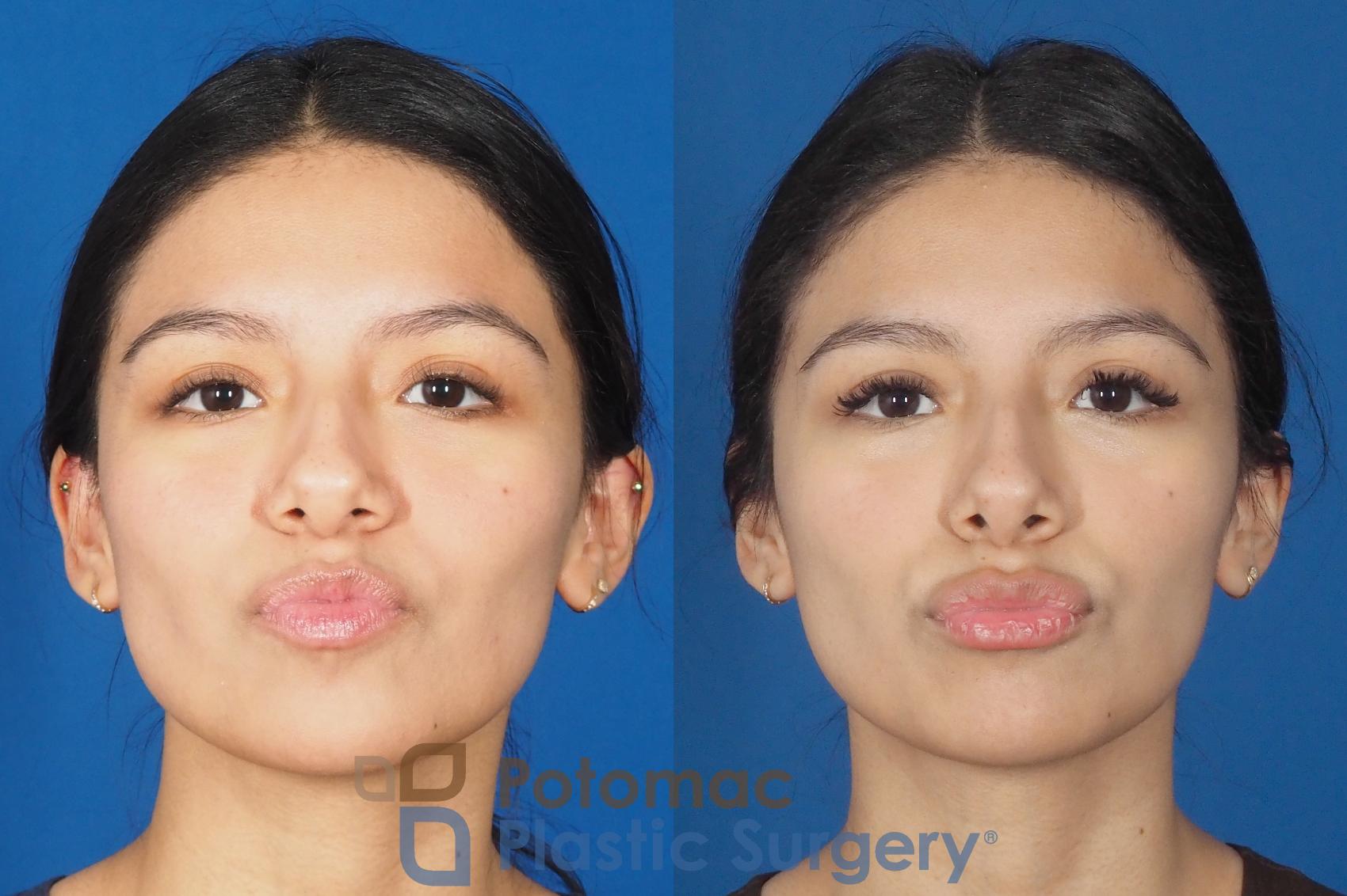 Lip Filler Injection In Young Woman By Nurse Injector 9977