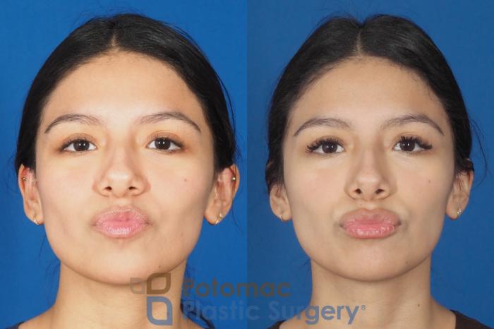 Before & After Dermal Fillers Case 308 Front - Kissing View in Washington DC & Arlington , DC