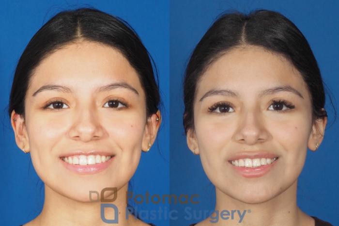 Before & After Liquid Facelift Case 308 Front - Smiling View in Washington DC & Arlington , DC