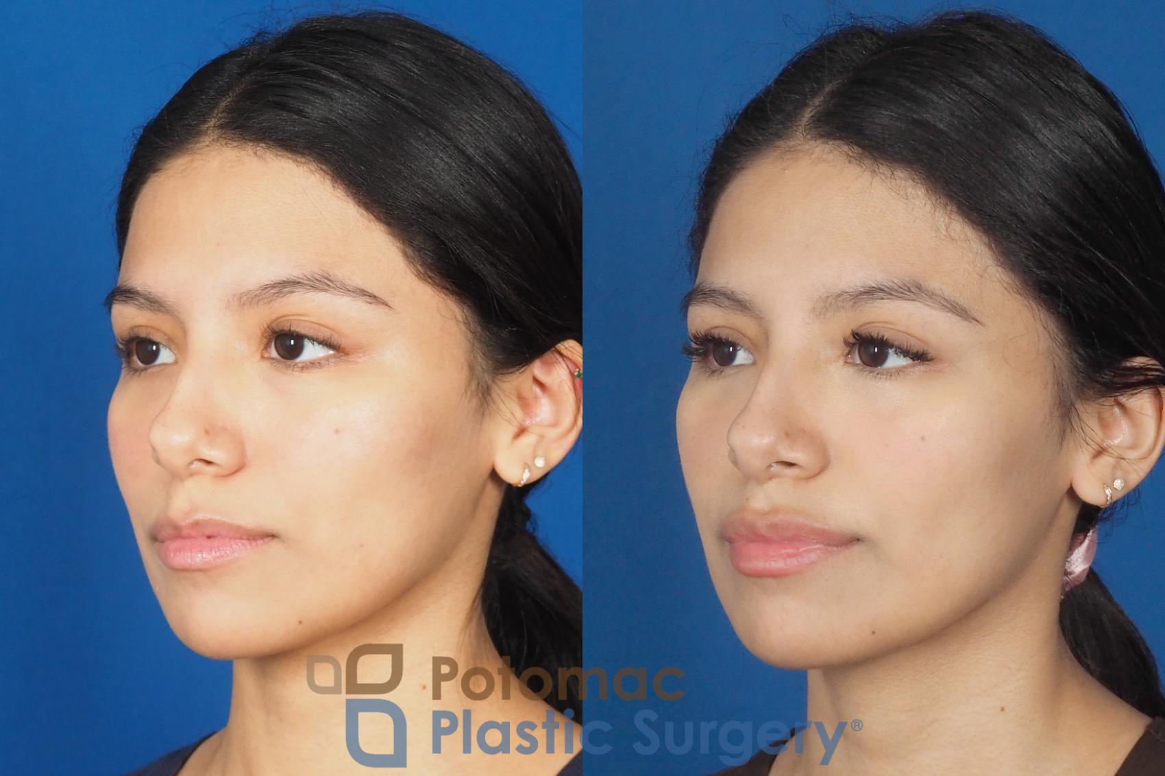 Before & After Liquid Facelift Case 308 Left Oblique View in Washington DC & Arlington , DC