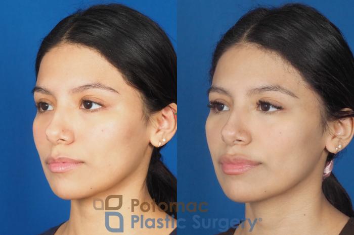 Before & After Lip Augmentation Case 308 Left Oblique View in Washington DC & Arlington , DC
