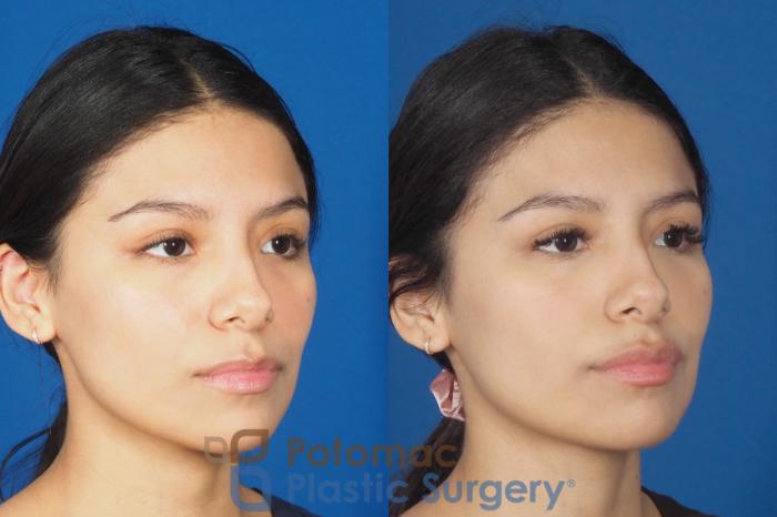 Before & After Dermal Fillers Case 308 Right Oblique View in Washington DC & Arlington , DC