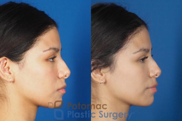 Before & After Lip Augmentation Case 308 Right Side View in Washington DC & Arlington , DC