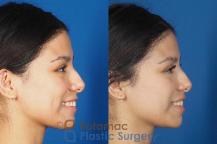 Before & After Lip Augmentation Case 308 Right - Smiling View in Washington DC & Arlington , DC