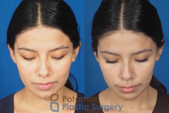 Before & After Dermal Fillers Case 308 Top View in Washington DC & Arlington , DC