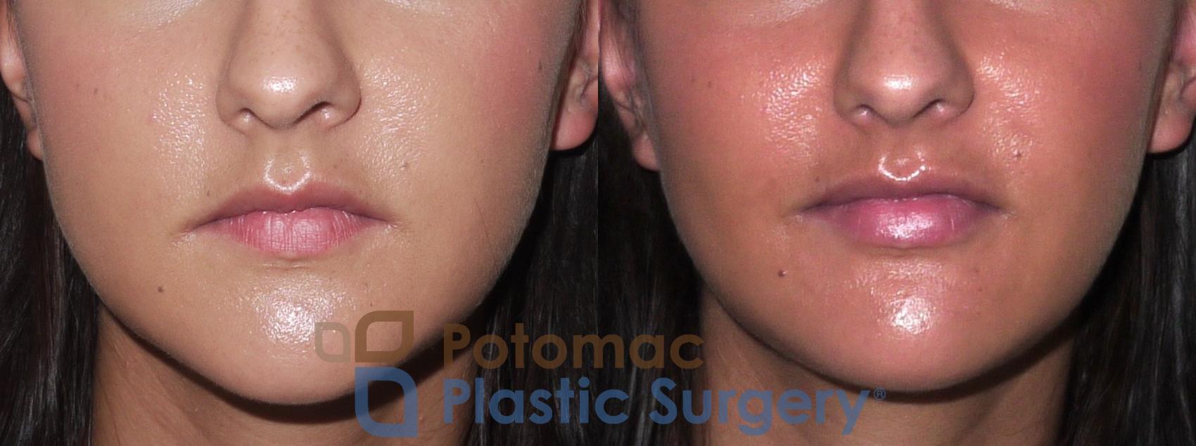 Before & After Dermal Fillers Case 31 Front View in Washington DC & Arlington , DC