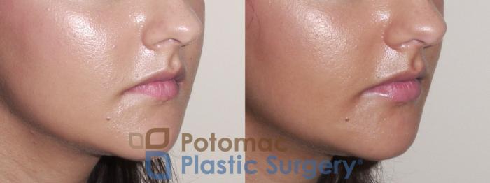 Before & After Lip Augmentation Case 31 Right Oblique View in Washington DC & Arlington , DC