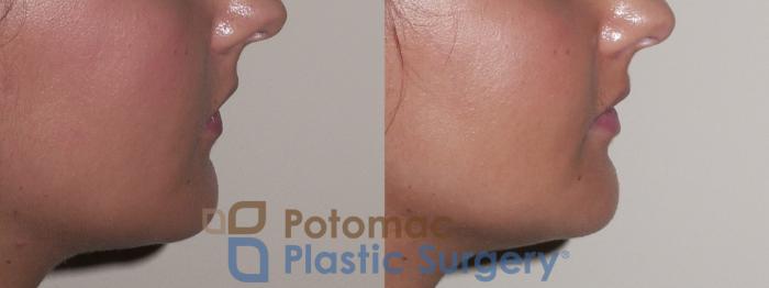 Before & After Lip Augmentation Case 31 Right Side View in Washington DC & Arlington , DC