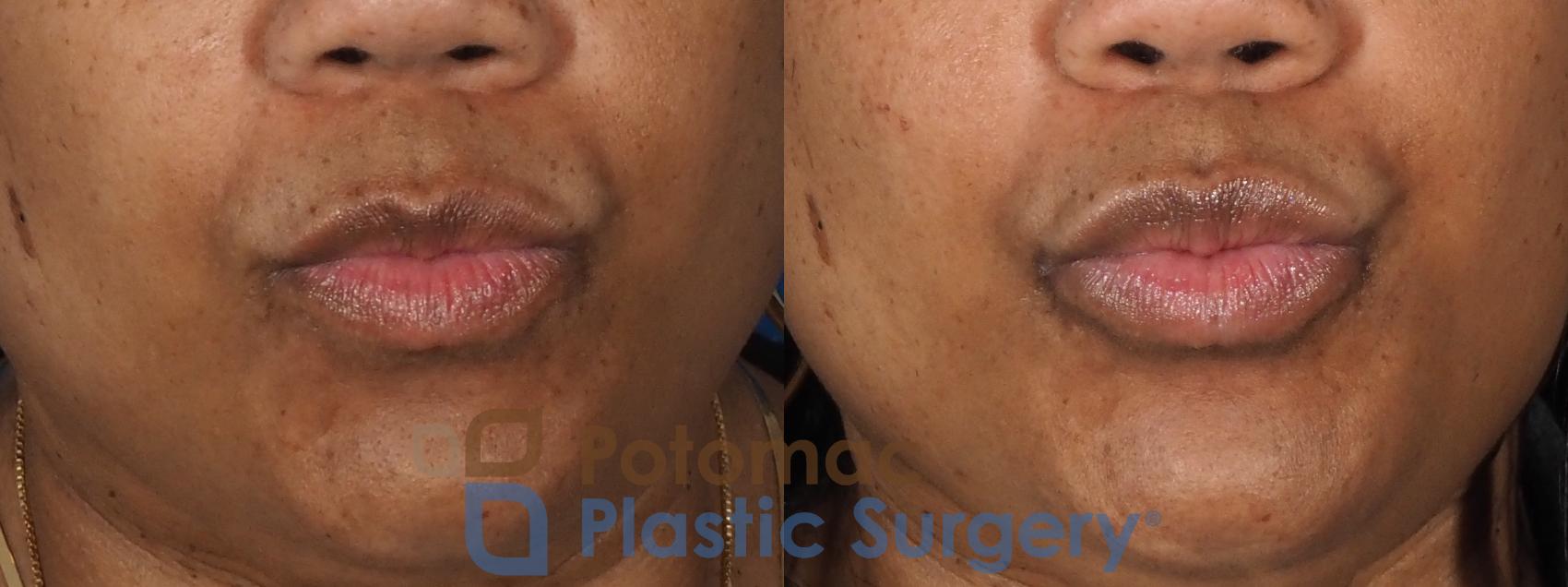 Before & After Lip Augmentation Case 339 Front - Puckering View in Washington DC & Arlington , DC