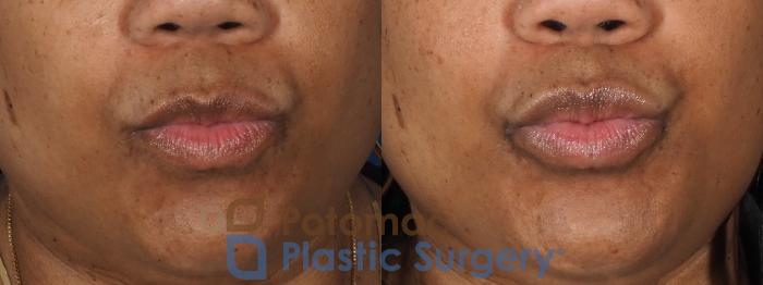 Before & After Lip Augmentation Case 339 Front - Puckering View in Washington DC & Arlington , DC