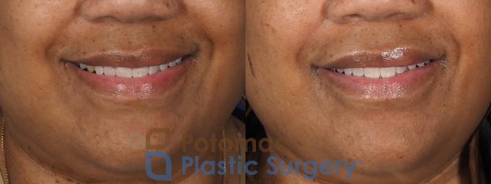 Before & After Lip Augmentation Case 339 Front - Smiling View in Washington DC & Arlington , DC