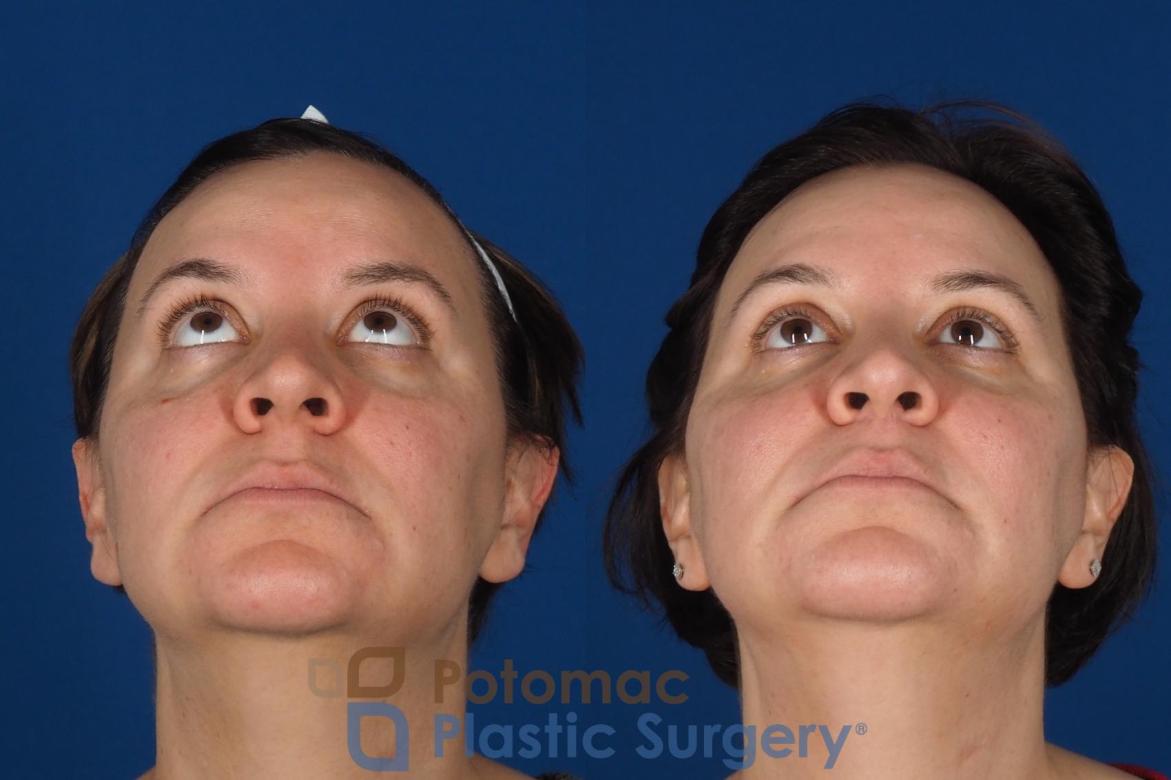 Before & After Lip Augmentation Case 353 Bottom View in Washington DC & Arlington , DC