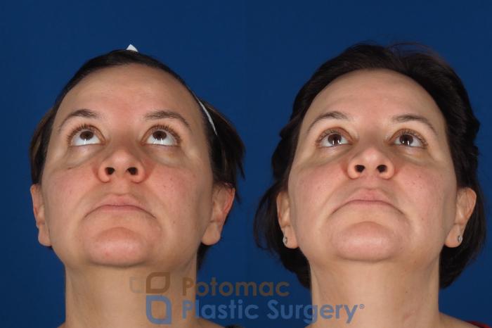 Before & After Lip Augmentation Case 353 Bottom View in Washington DC & Arlington , DC