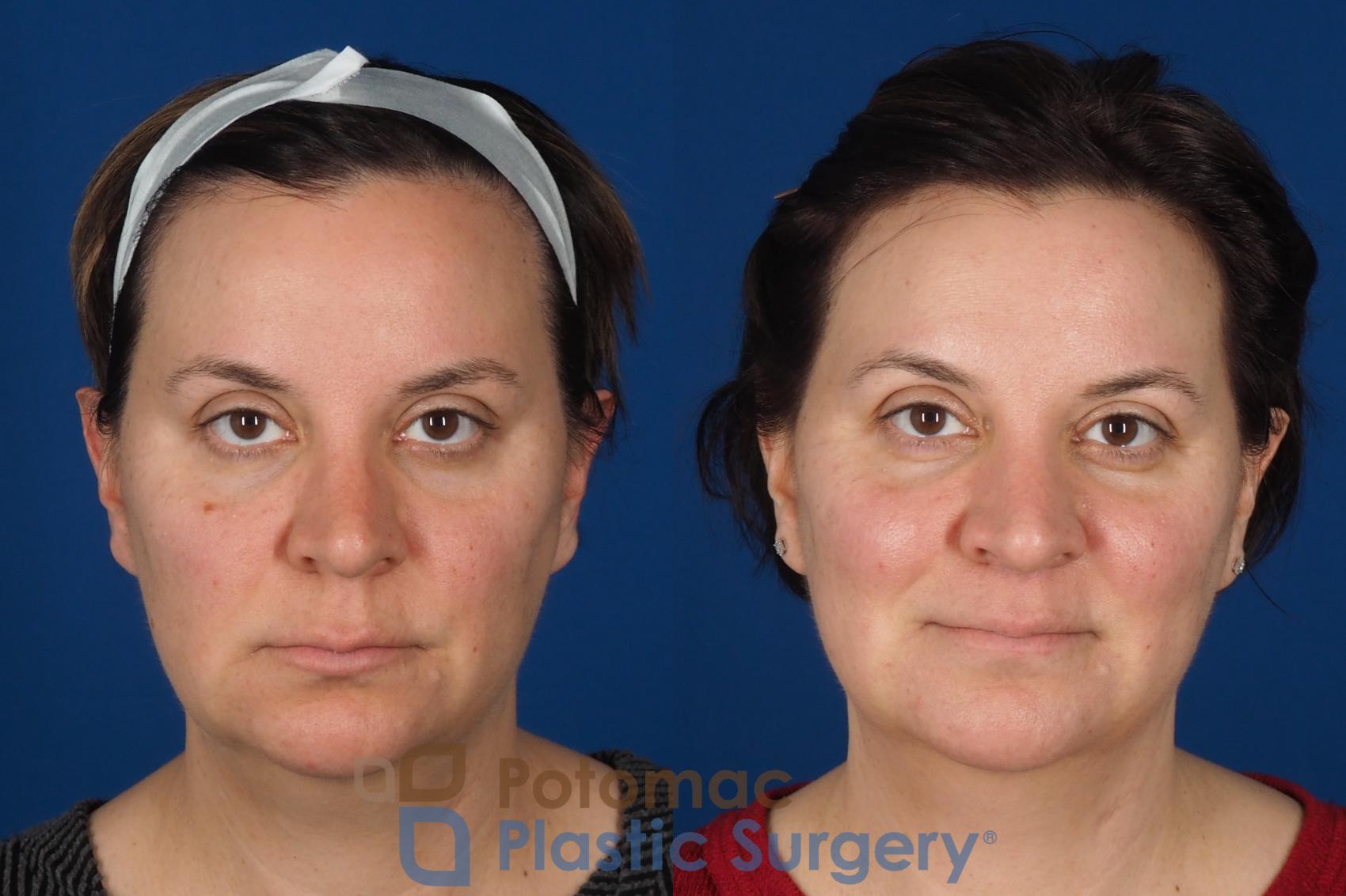Before & After Lip Augmentation Case 353 Front View in Washington DC & Arlington , DC