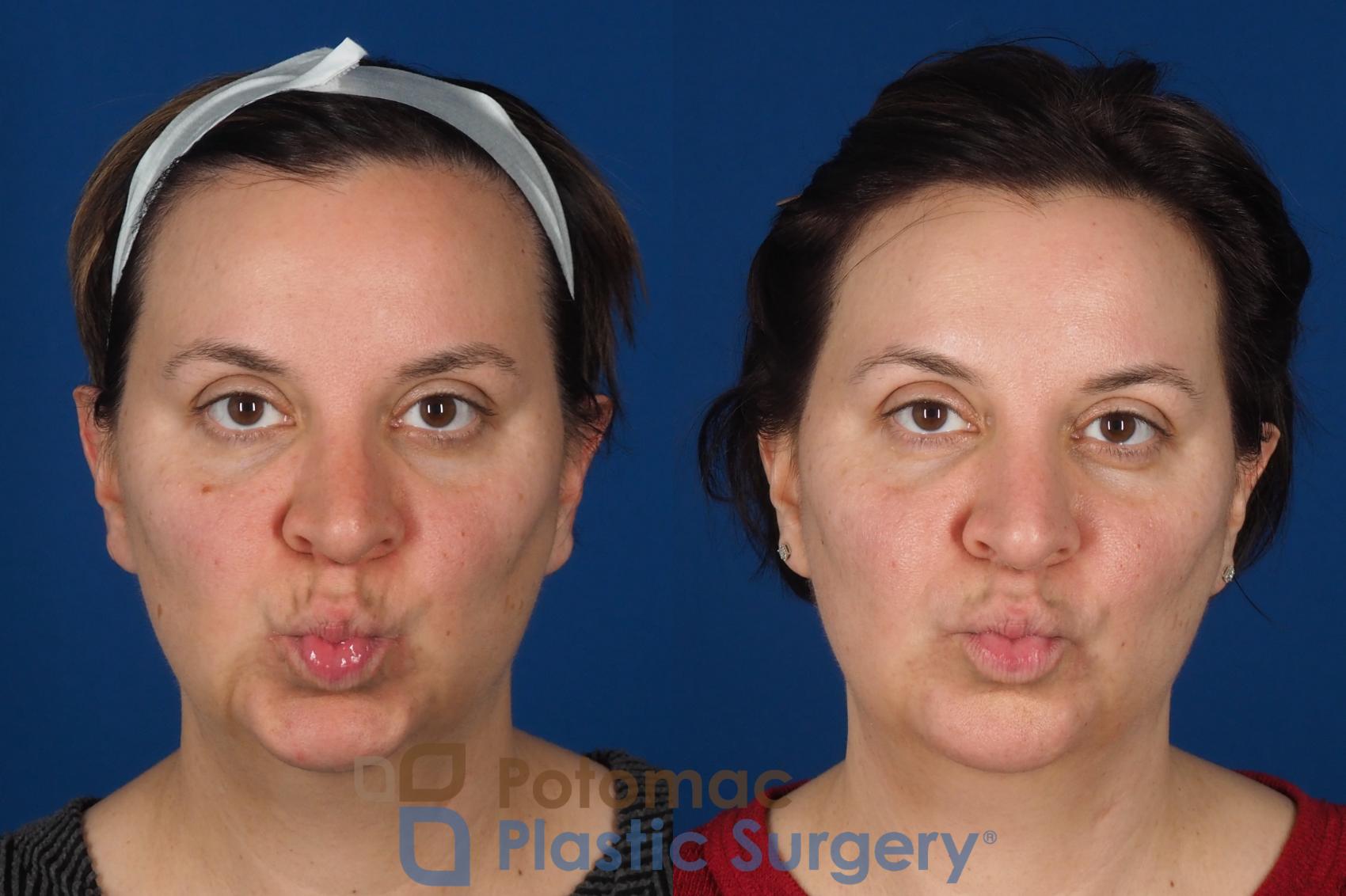 Before & After Lip Augmentation Case 353 Front - Puckering View in Washington DC & Arlington , DC