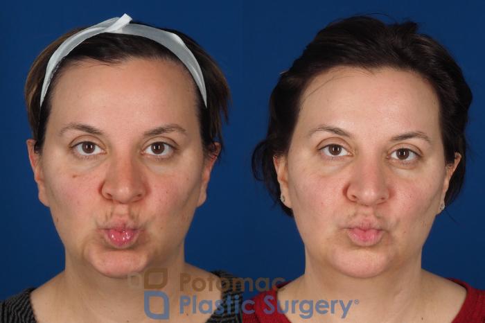 Before & After Lip Augmentation Case 353 Front - Puckering View in Washington DC & Arlington , DC