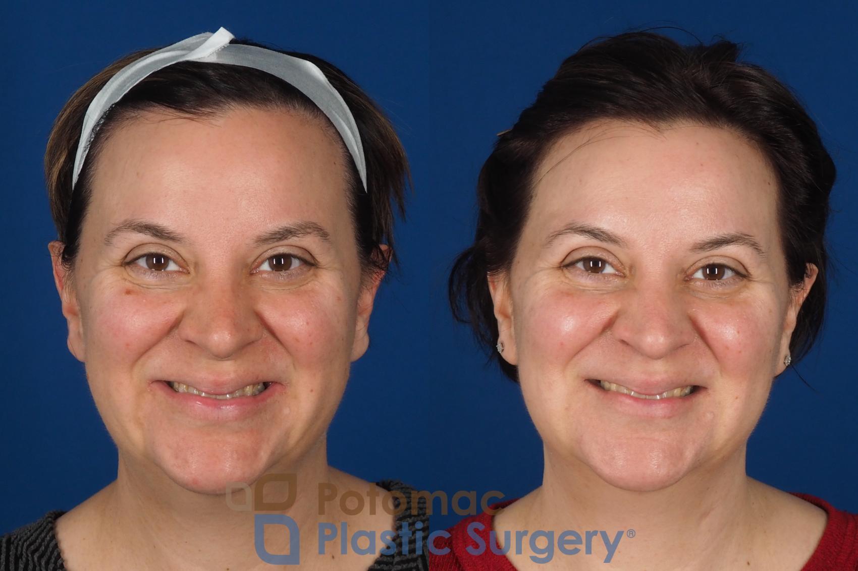Before & After Lip Augmentation Case 353 Front - Smiling View in Washington DC & Arlington , DC