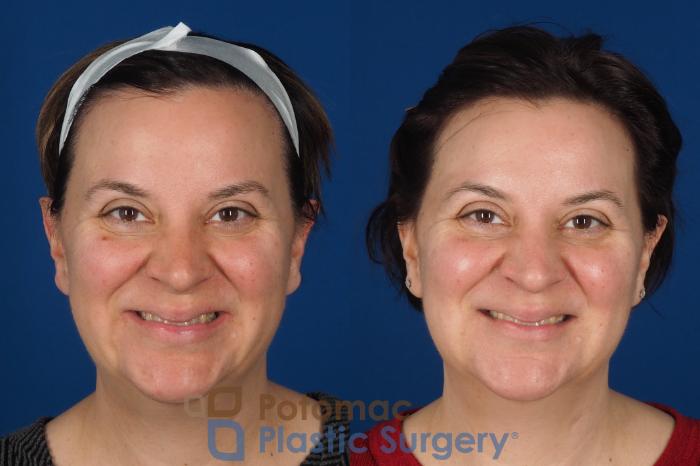 Before & After Lip Augmentation Case 353 Front - Smiling View in Washington DC & Arlington , DC