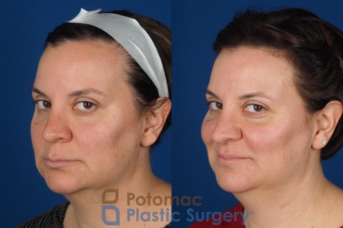Before & After Lip Augmentation Case 353 Left Oblique 2 View in Washington DC & Arlington , DC