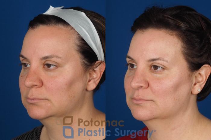 Before & After Lip Augmentation Case 353 Left Oblique View in Washington DC & Arlington , DC