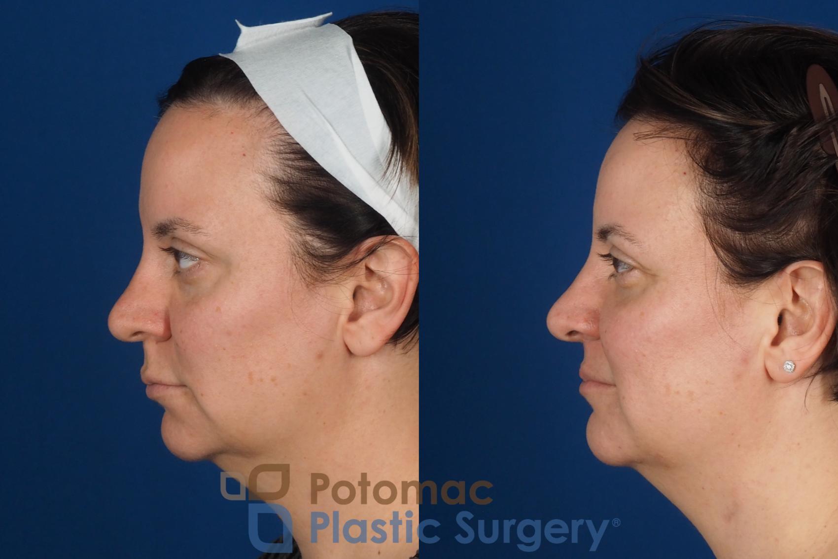 Before & After Lip Augmentation Case 353 Left Side View in Washington DC & Arlington , DC