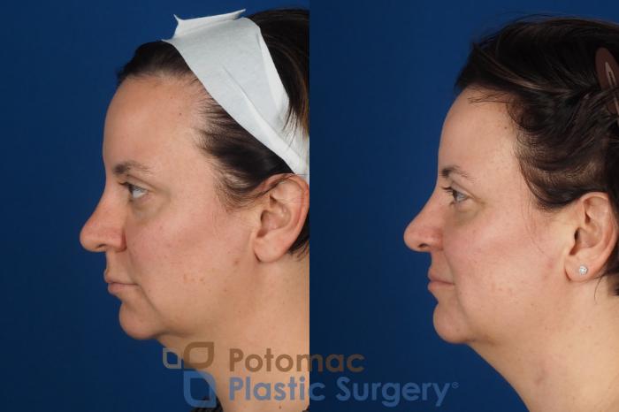 Before & After Lip Augmentation Case 353 Left Side View in Washington DC & Arlington , DC