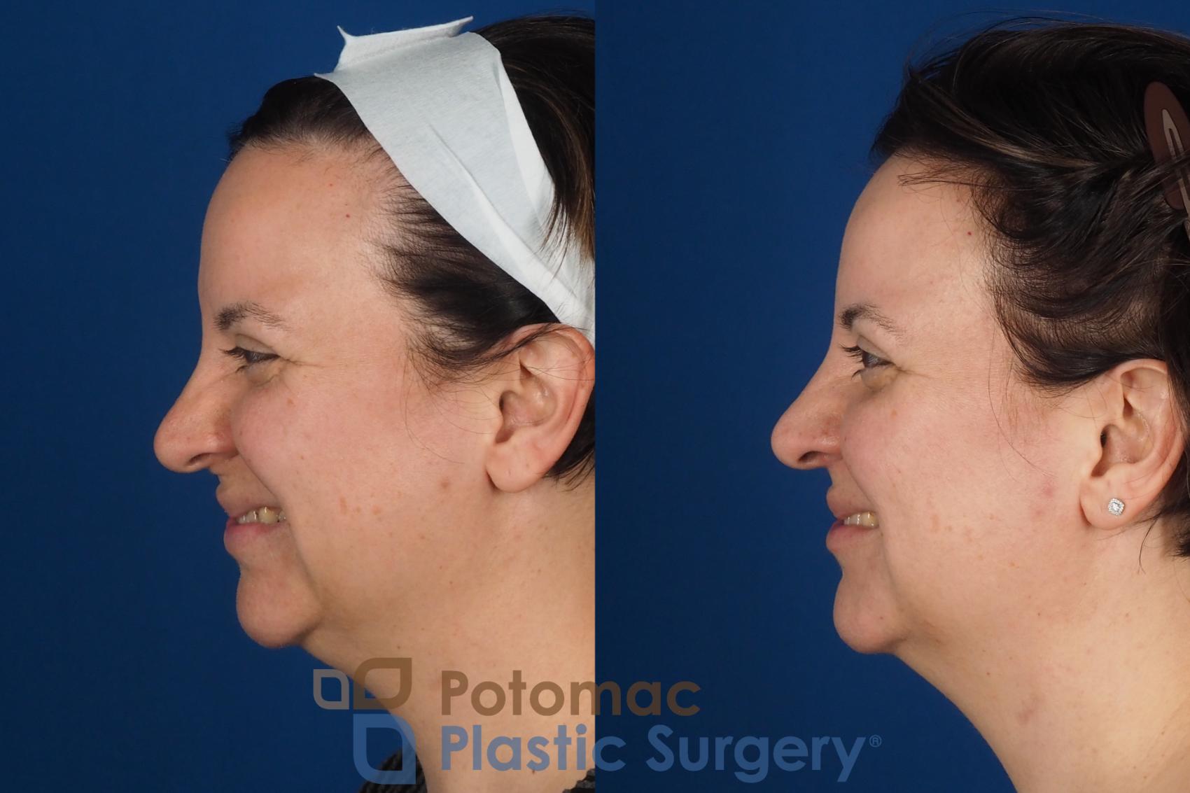 Before & After Lip Augmentation Case 353 Left - Smiling View in Washington DC & Arlington , DC