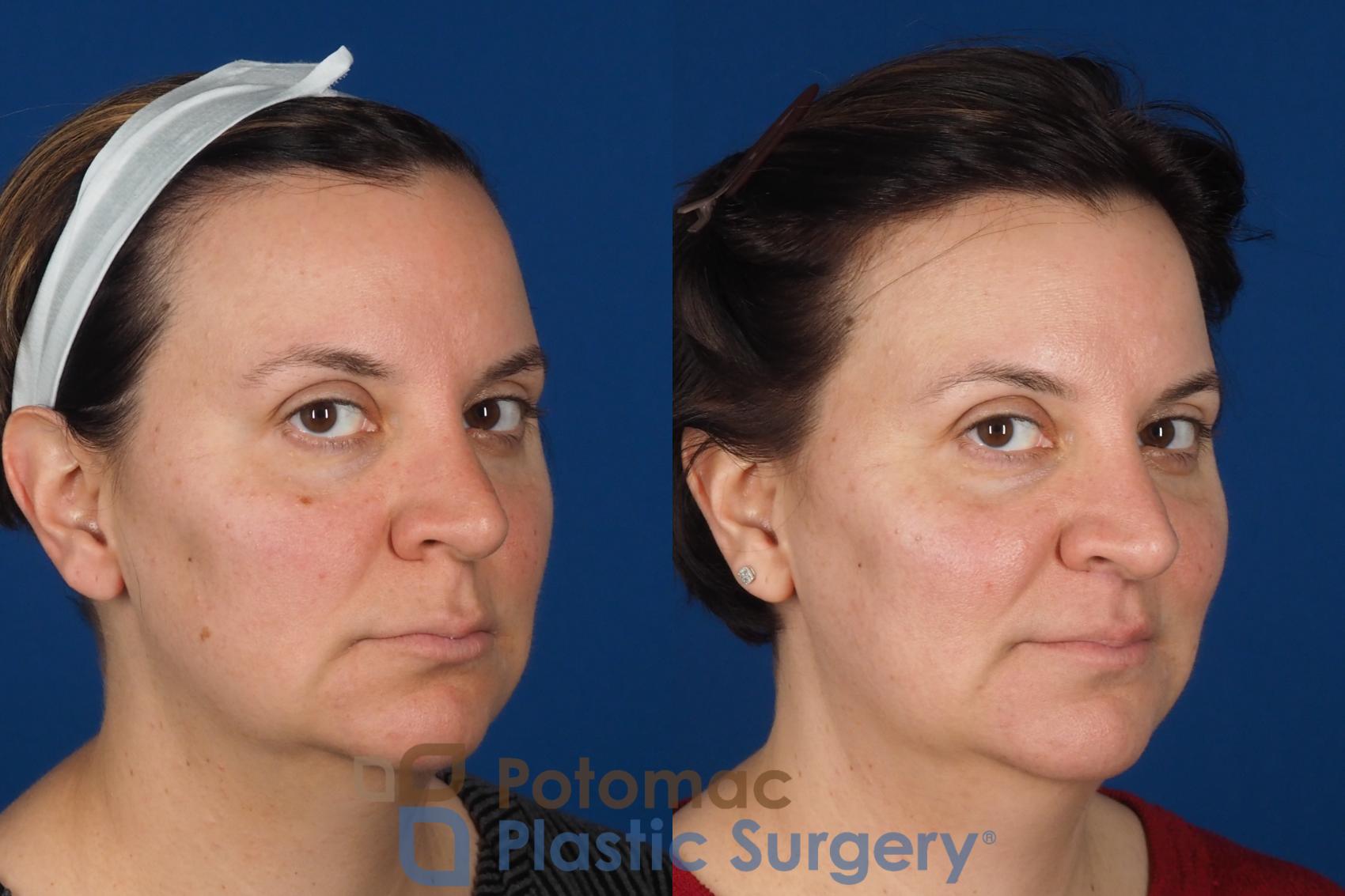 Before & After Lip Augmentation Case 353 Right Oblique 2 View in Washington DC & Arlington , DC