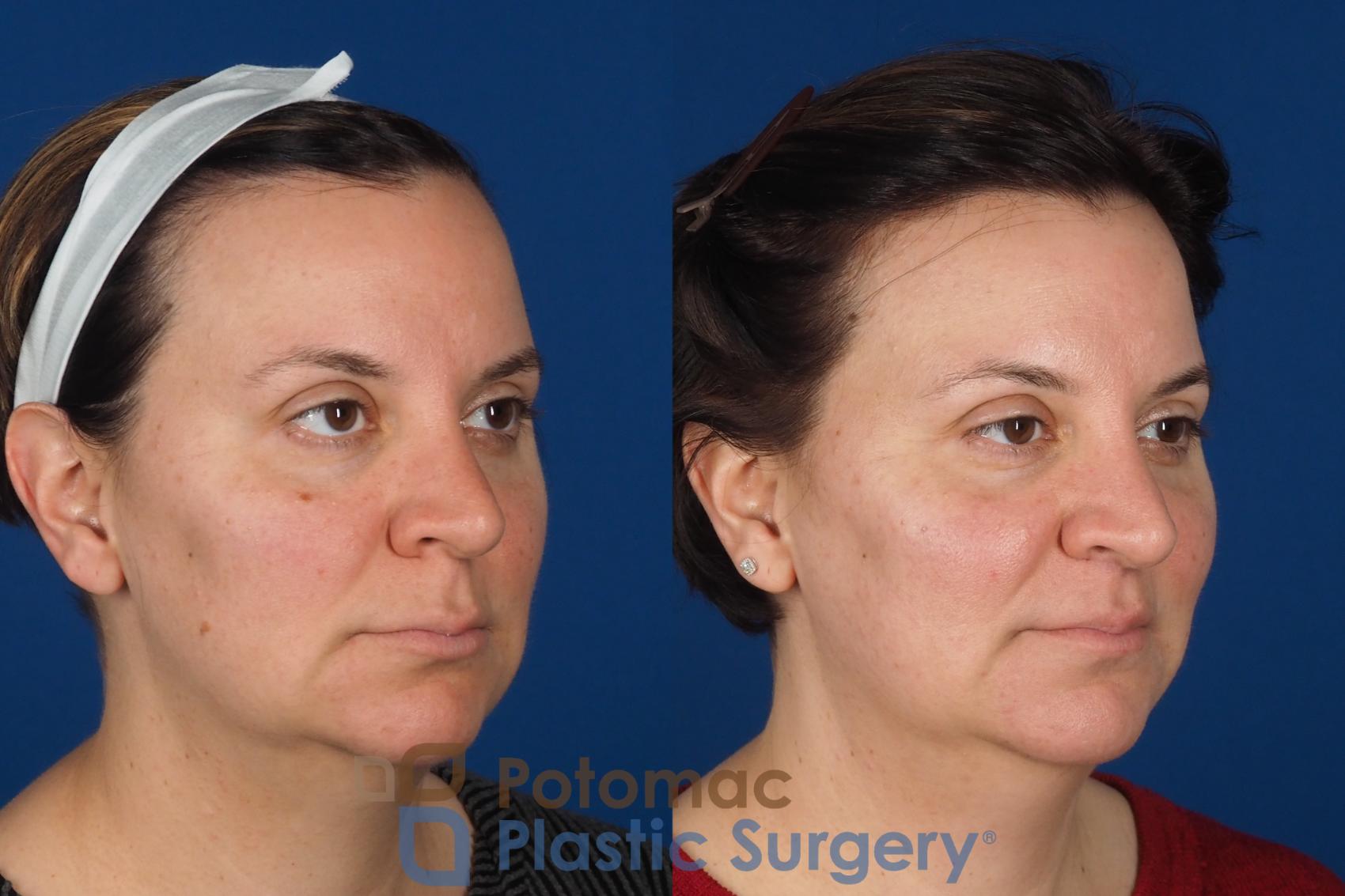 Before & After Lip Augmentation Case 353 Right Oblique View in Washington DC & Arlington , DC