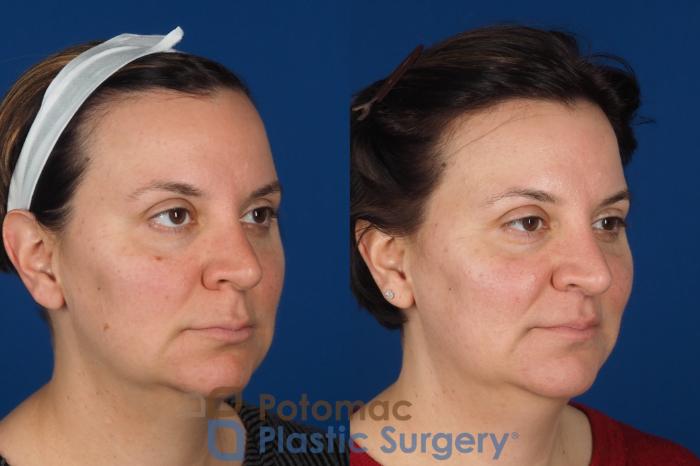 Before & After Lip Augmentation Case 353 Right Oblique View in Washington DC & Arlington , DC