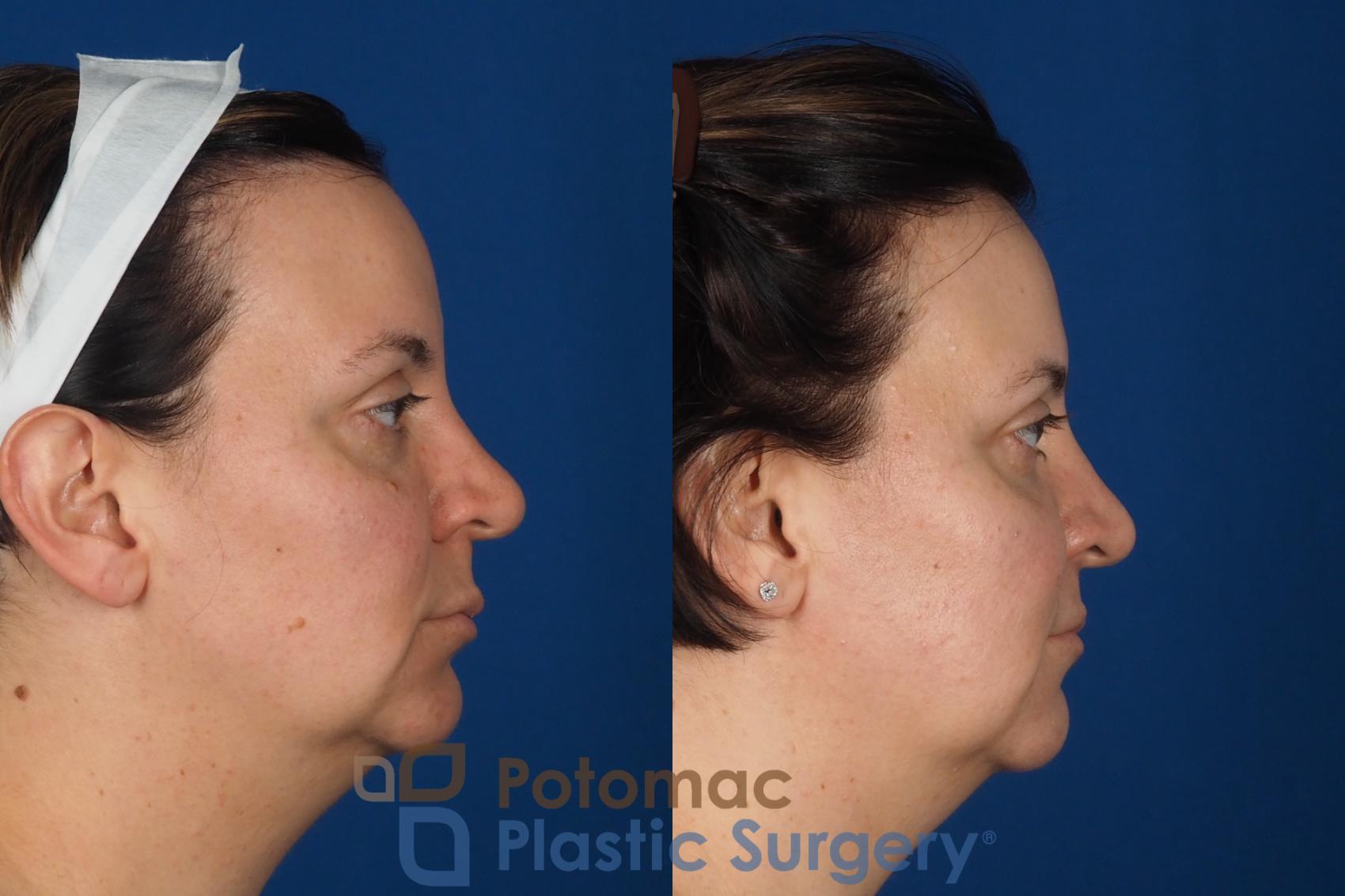 Before & After Lip Augmentation Case 353 Right Side View in Washington DC & Arlington , DC