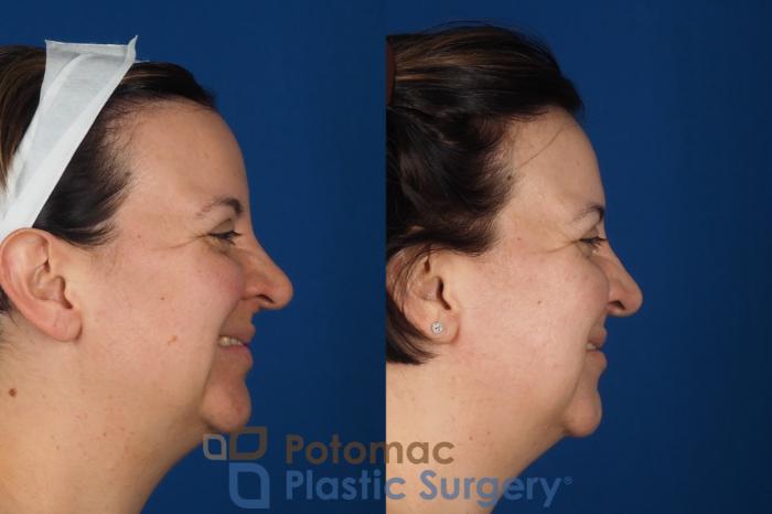 Before & After Lip Augmentation Case 353 Right - Smiling View in Washington DC & Arlington , DC
