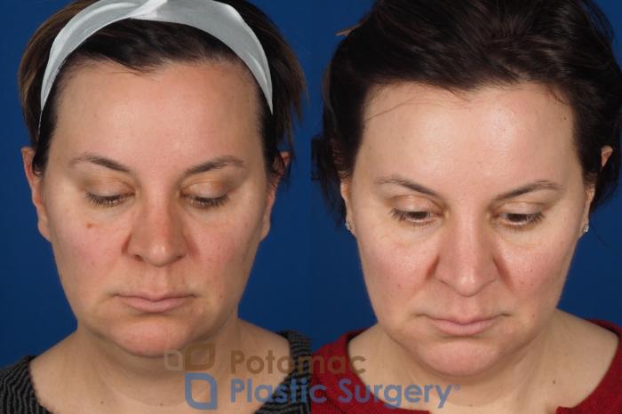 Before & After Lip Augmentation Case 353 Top View in Washington DC & Arlington , DC