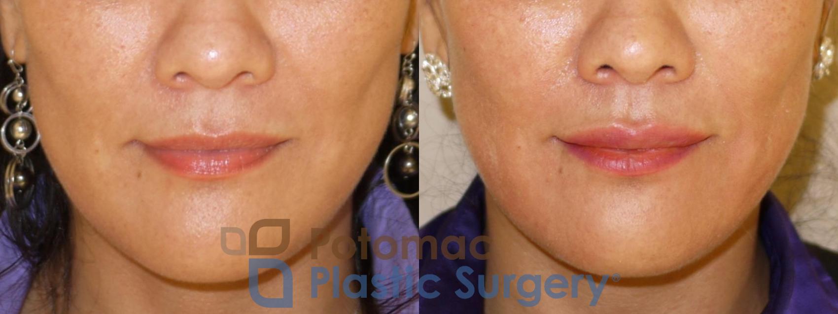 Before & After Dermal Fillers Case 37 Front View in Washington, DC