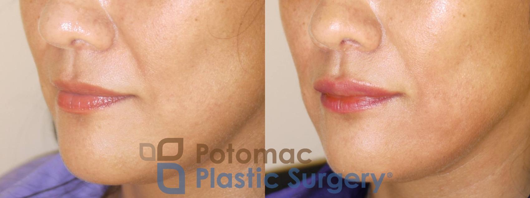 Before & After Lip Augmentation Case 37 Left Oblique View in Washington DC & Arlington , DC