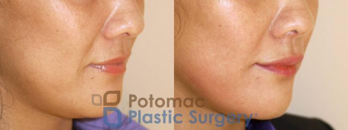 Before & After Dermal Fillers Case 37 Right Oblique View in Washington DC & Arlington , DC