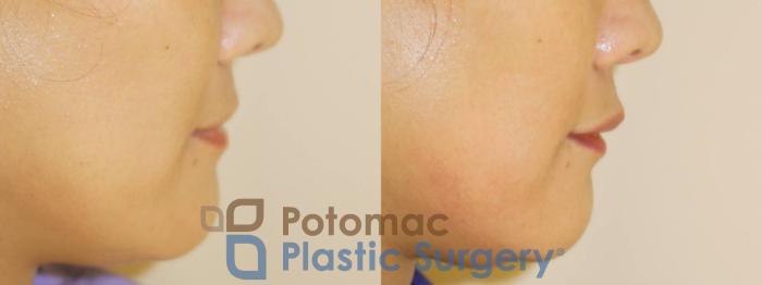 Before & After Dermal Fillers Case 37 Right Side View in Washington DC & Arlington , DC