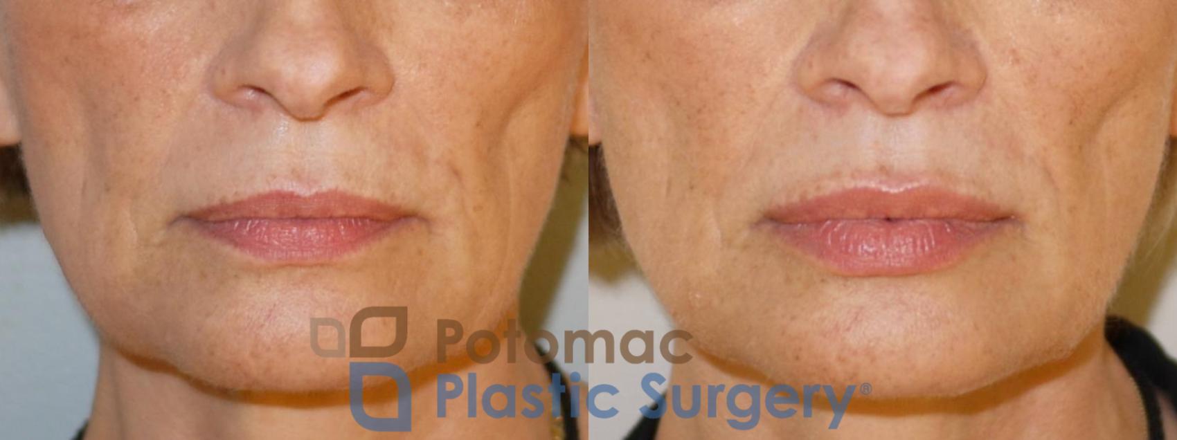 Before & After Dermal Fillers Case 55 Front View #1 View in Washington, DC
