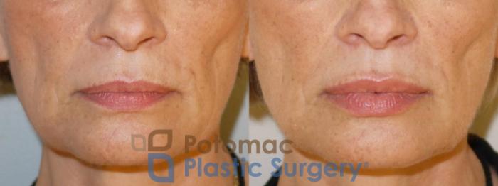 Before & After Dermal Fillers Case 55 Front View #1 View in Washington DC & Arlington , DC