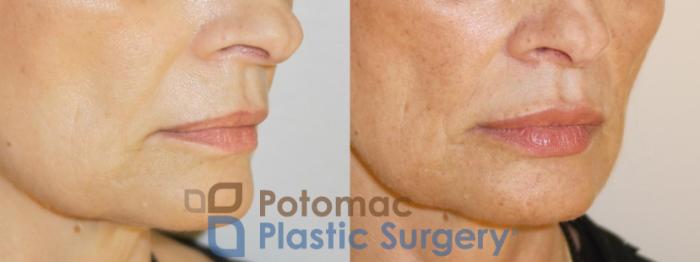Before & After Dermal Fillers Case 55 Right Oblique View in Washington DC & Arlington , DC