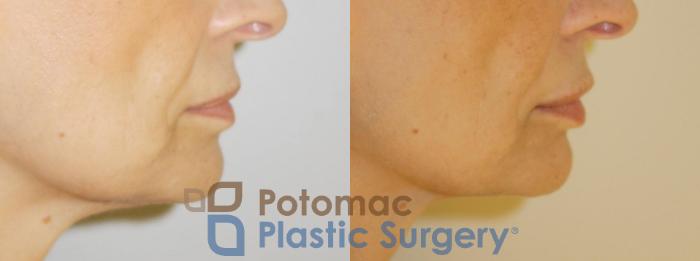 Before & After Dermal Fillers Case 55 Right Side View in Washington DC & Arlington , DC
