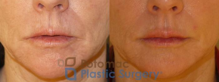 Before & After Lip Augmentation Case 56 Front View #1 View in Washington DC & Arlington , DC