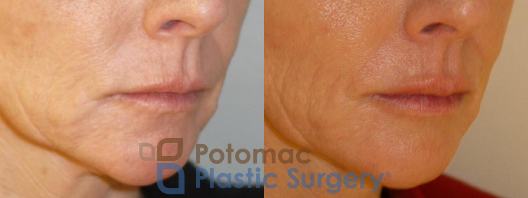 Before & After Lip Augmentation Case 56 Right Oblique View in Washington, DC