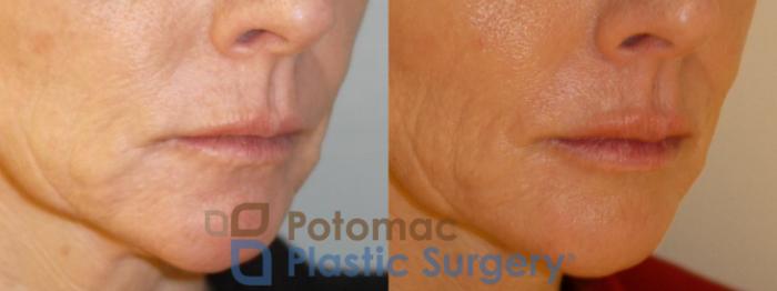 Before & After Dermal Fillers Case 56 Right Oblique View in Washington, DC