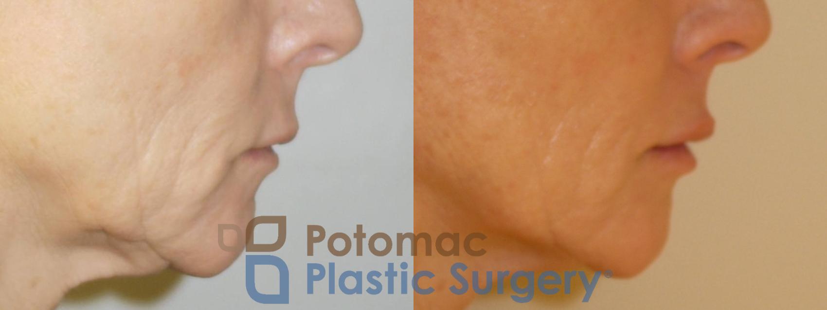 Before & After Lip Augmentation Case 56 Right Side View in Washington, DC