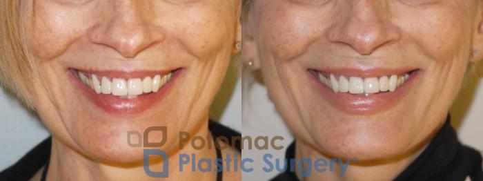 Before & After Lip Augmentation Case 75 Front - Smiling View in Washington DC & Arlington , DC